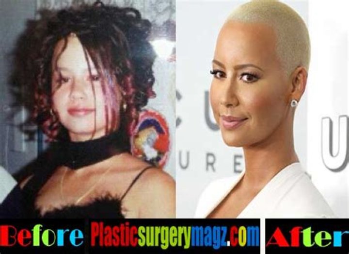 Amber Rose Before and After Surgery: A Comprehensive Journey