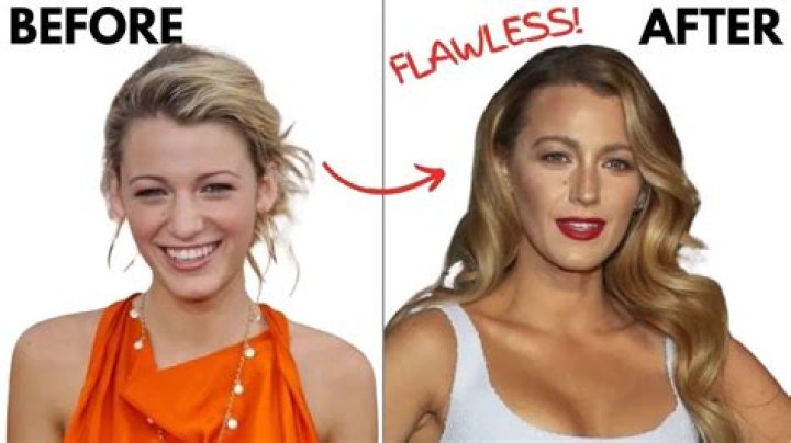 Blake Lively Mole Removal: A Comprehensive Guide to Her Journey and Skincare Secrets