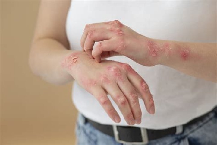 Can Doxycycline Cause Burning Skin: A Comprehensive Guide