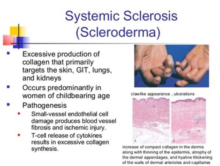 Can Limited Scleroderma Become Systemic? Understanding Progression and What to Know