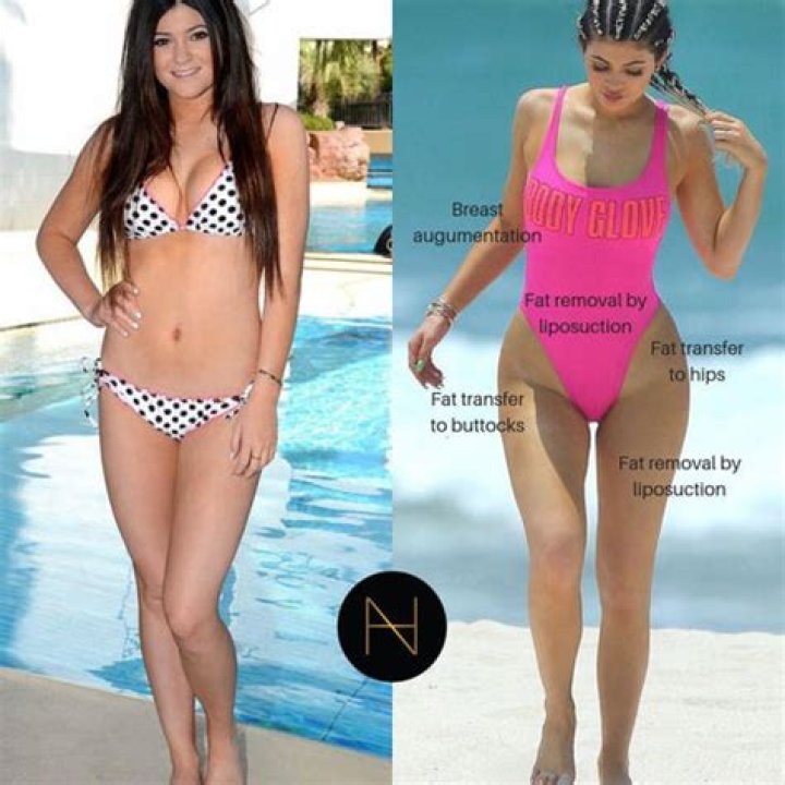Did Kylie Jenner Get a BBL? Unpacking the Rumors Around Her Changing Look