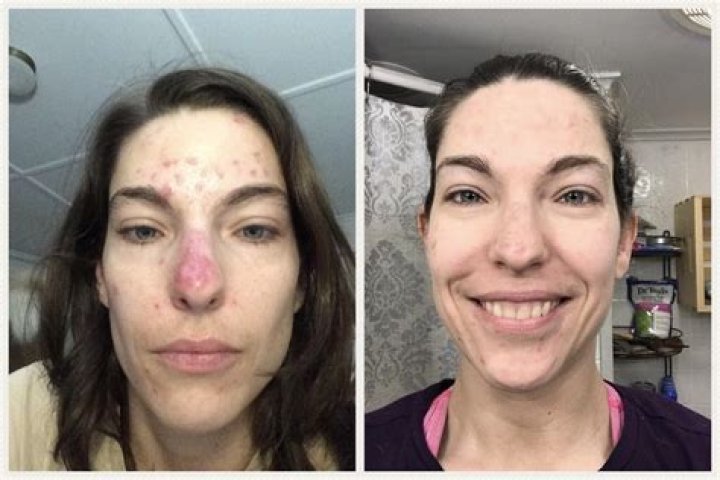 Does Lupus Cause Weight Gain? Exploring the Connections