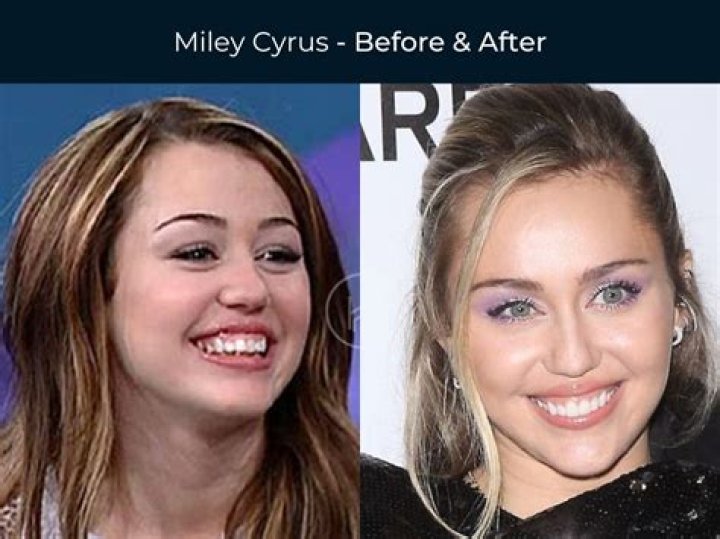 Does Miley Cyrus Have Dentures? Unpacking the Buzz About Her Smile