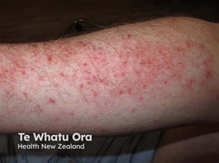 Doxycycline Photosensitivity Rash: What You Need to Know