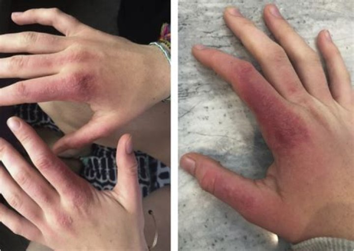 Doxycycline Sunburn Hands: Understanding the Risks and How to Protect Your Skin