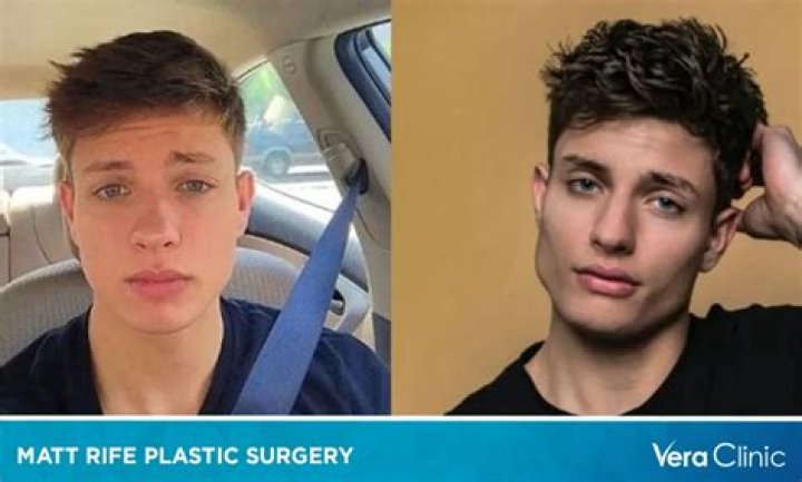 Matt Rife Face Change: The Fascinating Journey of Transformation