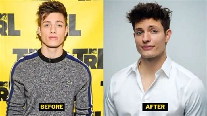 Matt Rife Plastic Surgery: Transforming Lives Through Expert Care
