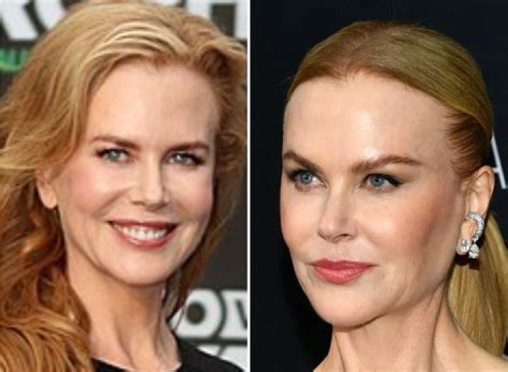Nicole Kidman Plastic Surgery: A Comprehensive Look at Her Transformations and Beauty Secrets