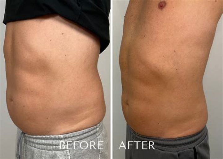 Uncover The Secrets Of Non-Invasive Liposuction In Sarajevo