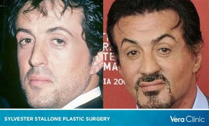 Sylvester Stallone Plastic Surgery Before and After: The Untold Story