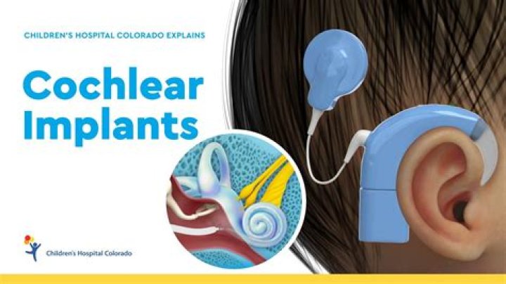 A Revolutionary Journey Into The World Of Cochlear Implants