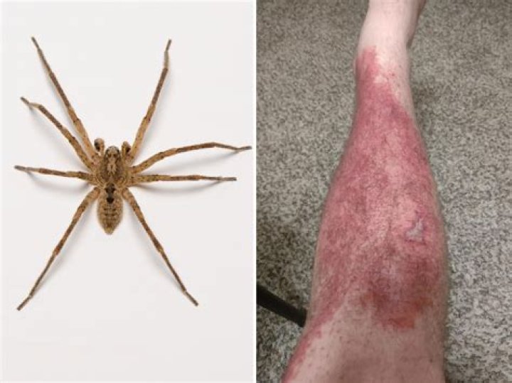 Identifying Spider Bites: What Does a Spider Fang Bite Look Like?