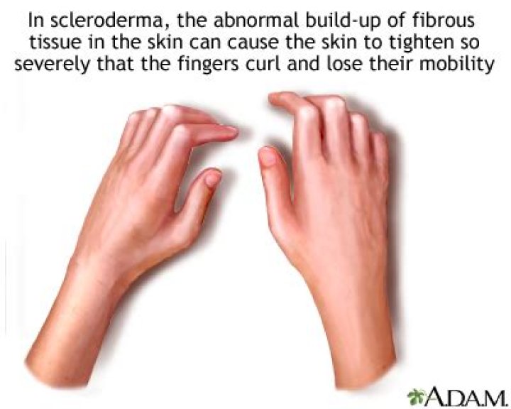 What is the History of Scleroderma? Tracing a Complex Condition Through Time
