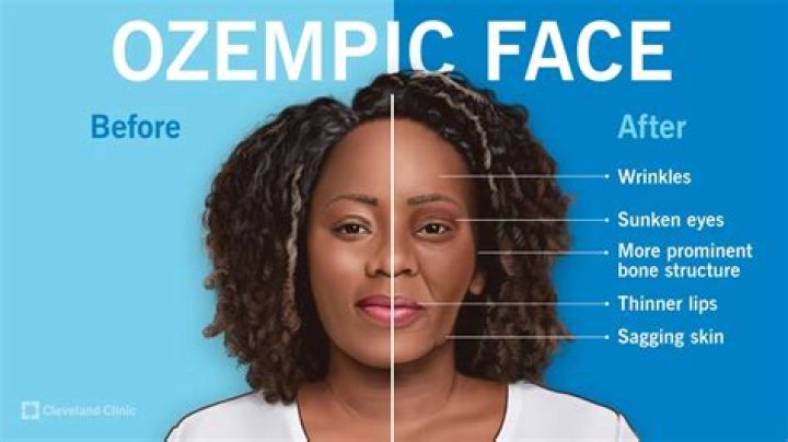 What is the Ozempic Face? Understanding Rapid Weight Loss and Facial Changes