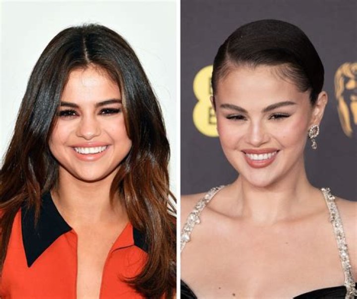 Why Did Selena Gomez Get Veneers? Unpacking Her Smile Transformation