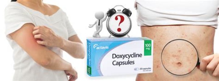 Why Does Doxycycline Cause Sun Sensitivity: A Comprehensive Guide